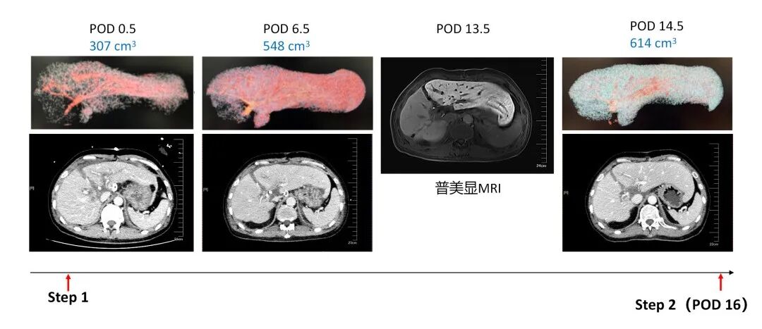 First-in-Guangdong Auxiliary Liver Transplantation with a Discarded Graft: Novel Approach Harnesses Rapid Liver Regeneration to Convert Small-Volume Hepatic Tissue into a Fully Functional Graft